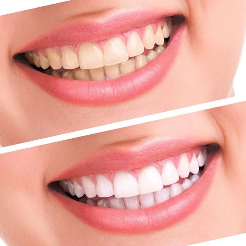 Luma Smile – Aparat za poliranje i izbeljivanje zuba