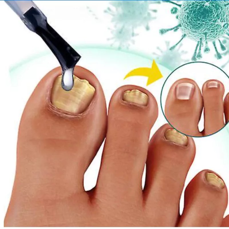 2 u 1 serum protiv gljivica na noktima