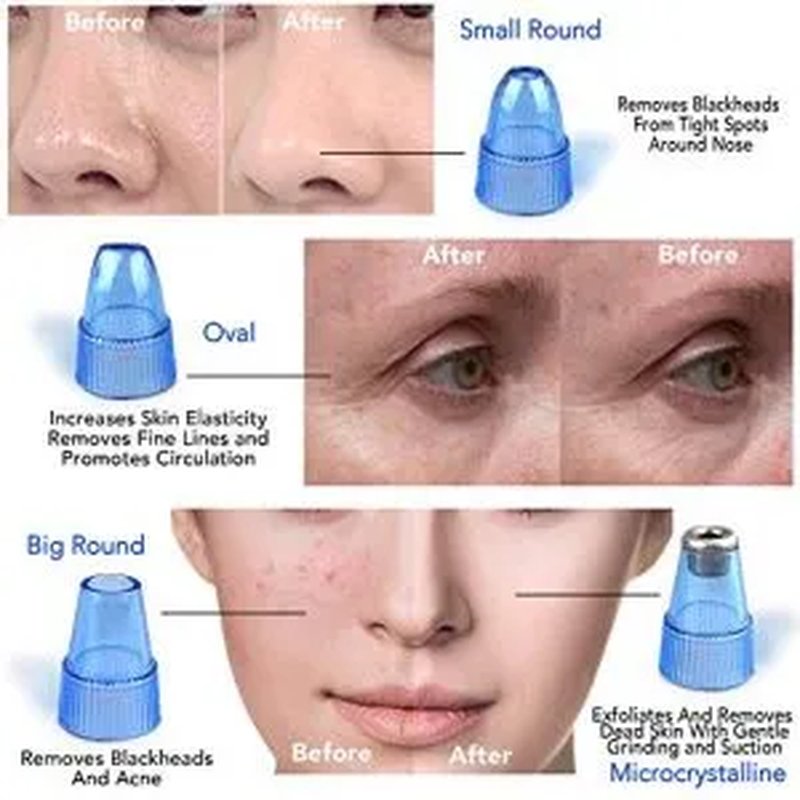 Dermasuction – Aparat za čišćenje pora i mitisera